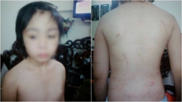 SỐC: Bé trai 10 tuổi ở Hà Nội nghi bị bố và mẹ kế bạo hành gãy ...