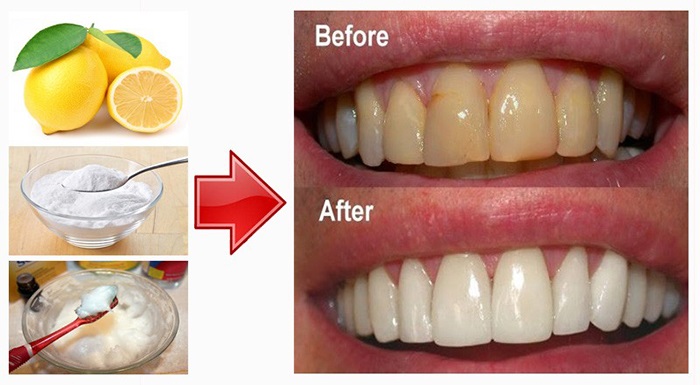 10 cách làm trắng răng tự nhiên bạn cần biết
