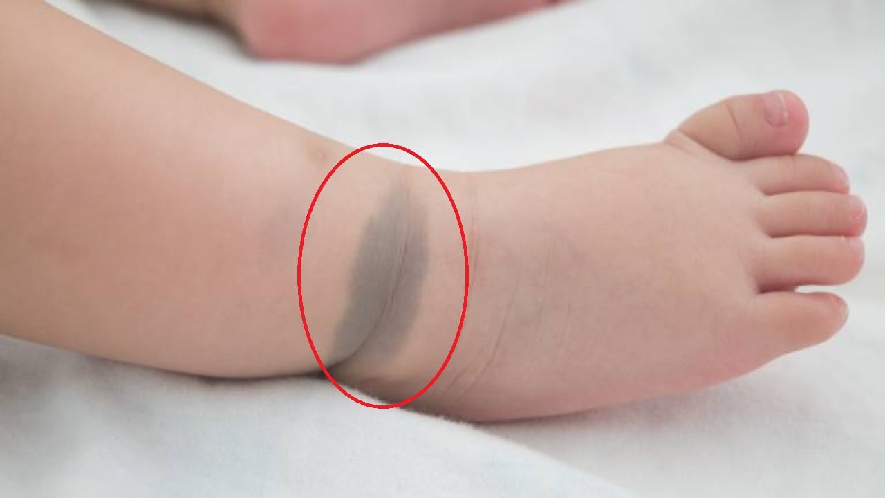 Trẻ c&oacute; vết bớt ở 6 vị tr&iacute; n&agrave;y, dự b&aacute;o số mệnh thi&ecirc;n kim, tương lai ph&uacute; qu&yacute;